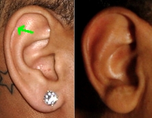 ears with and without Darwin's tubercle