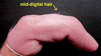 Myths of Human Genetics: Mid-digital Hair