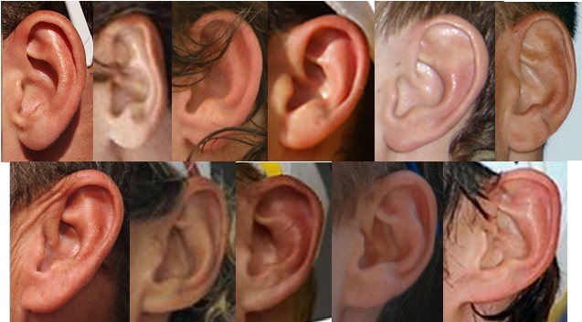 fused ear lobes