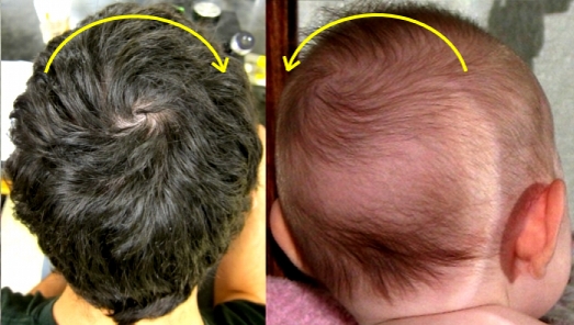 Myths of Human Genetics: Hair Whorl