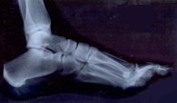 X-ray of human foot